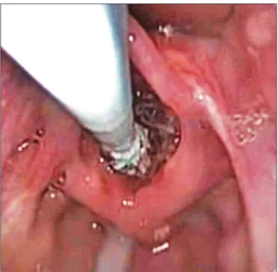 Figure 2. Direct laryngoscopy with a zero degree scope, showing the  catheter being introduced in the larynx, with the balloon completely  deflated