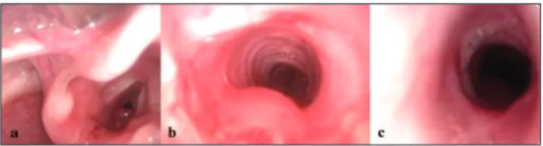 Figure 3. Patient with grade 3 subglottic stenosis and granulation tissue  (3A), submitted to balloon laryngoplasty (3B – image taken immediately  after dilatation, and 3C – image taken 2 weeks after the procedure, with  residual grade 1 stenosis - posteri