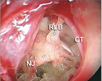 Figure 3. 30 degree scope endoscopic view of the oval window niche. 