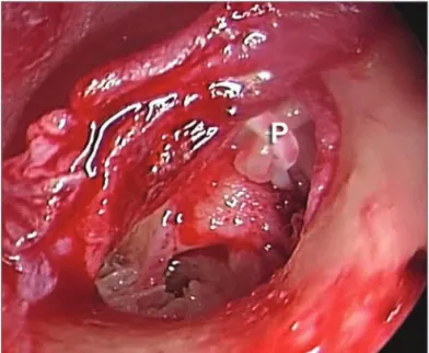 Figure 4. Endoscopic view (30 degree instrument) of the Teflon pros- pros-thesis (P) in place.