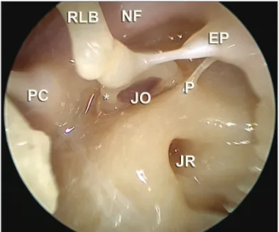 Figure 6. Endoscopic image of the anatomical dissection after removal  of the ear drum, with a 30 degree scope, showing the type of image  which can be achieved by means of endoscopic approaches