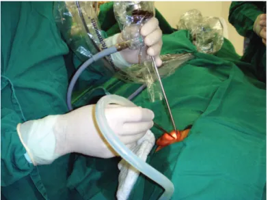 Figure  7.  Figure  showing  how  the  endoscope  is  positioned  inside  the  external  auditory  canal,  as  well  as  hand  position  -  one  holding  the endoscope and the other holding the instruments