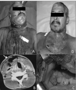 Figure 1. A) Extensive erythematous area associated with bilateral  submandibular, submentonian, and sublingual edema extending  to  the  neck  and  thorax