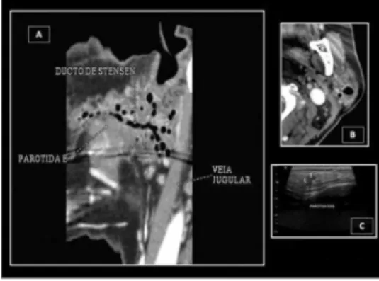 Figura  1. Aspecto  radiológico  da  pneumoparotidite  por  tomo- tomo-grafia (A e B) e por ultrassonotomo-grafia (C).