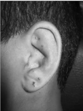 Figura 1. Herpes-zoster oticus.
