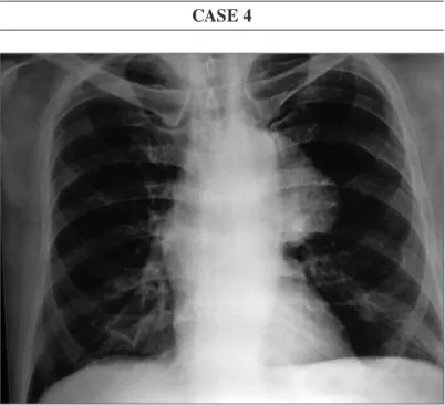 Figure 1. Chest X-ray PA view showing well- defined lobulated medias- medias-tinal lesion on the left side.