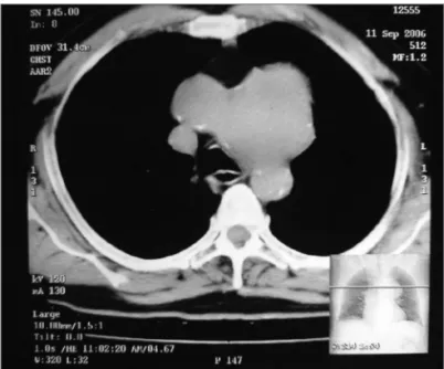 Figure 2. Plain CT scan chest, axial view showing large lobulated mass  in the anterior mediastinum.