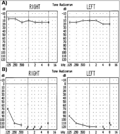 Figure 2. T1189C in 12S rRNA - (A) Partial chromatogram sequences  of the 12S rRNA gene in T1189C carriers, and (B) Partial sequence  alignment of the 12S rRNA gene in different species showing that the  position 1189 is highly conserved.