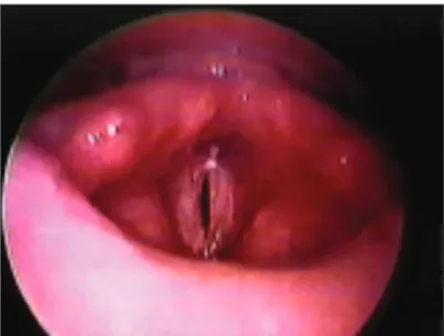 Table 2. Posterior Glottic Stenosis – Patient Data.