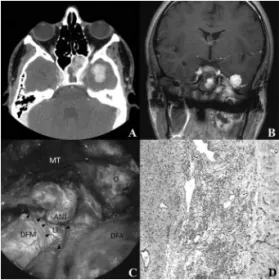 Figure  1.  A)  Axial  CT  showing  the  JNA  with  sphenoid  sinus  involvement and intradural extension, irrigated by ICA branches