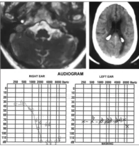 Figure  1.  Complementary  tests.  Upper  left-hand  image:  MRI  showing an acoustic neuroma to the right (arrow); upper  right-hand image: skull CT showing a hypodense area near the right  ventricle  horn  (circle);  lower  image:  tonal  audiometry  sho
