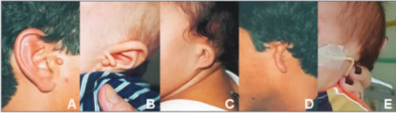 Figure 1. Images showing different grades of microtia in patients of  the study sample: normal ear with preauricular appendage (A); grade I  microtia with preauricular appendages (B); grade II microtia (C); grade  Iii microtia (D), grade IV microtia or ano