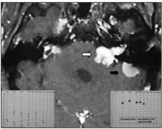 Figura 1. Ressonância magnética (T1 com contraste) revelando  schwannoma  vestibular  à  esquerda  (seta  branca),  associado  à meningioma da face medial do osso petroso esquerdo (seta  preta)