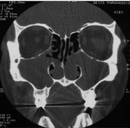 Figure 1. CT of the paranasal sinuses - coronal section showing  tumors in both maxillary sinuses, which extend to the nasal cavity  through the middle meati.