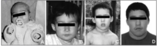 Figure 1. Craniofacial features of the patient at different ages: 16  days (A), 1 year and 11 months (B), 4 years (C), and 13 years (D).