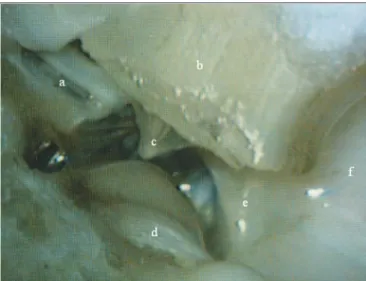 Figure 1. Medial wall view: a) epitympanic; b) external ear canal; c)  tympanic  membrane;  d)  Jacobson’s  nerve;  e)  hypotympanum;  f)  tympanic bulla.