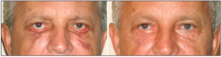 Figure 2. Patient with left lower eyelid malpositioning after blepharo- blepharo-plasty caused by retraction.
