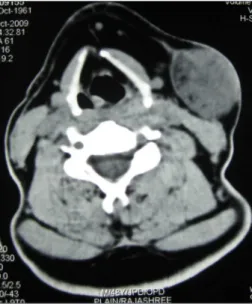 Figure  1.  ct  scan  (axial  )  -  ct  scan  showing  a  3.2x4.2  cm  soft  tissue density with tiny densities of fat attenuation