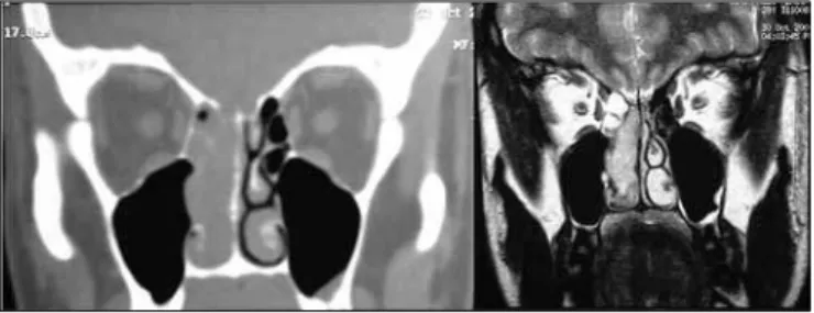 Figure  3.  Preoperative  CT  and  MRI  of  patient  IGM,  stage  Kadish  C  and Dulguerov T3n0.