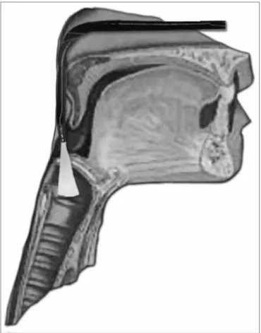 Figure  5a.  Positioning  the device  in  order  to  assess  the deglutition  function.