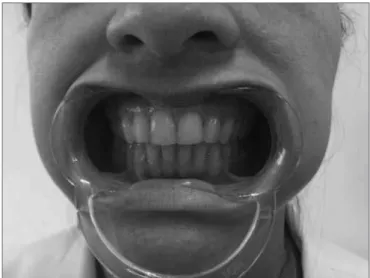 Figure 4. Mandible lateralization to the right.