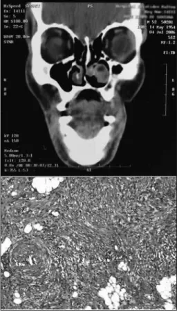 Figure 1. ABOVE: CT scan showing a tumor in the left inferior  meatus, without signs of bone destruction.