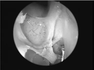 Figure 1. Exposed anterior ethmoid artery - subperiosteal plane, left  orbit  -  during  endoscopic  dissection  of  a  cadaver  (45°  endoscope)