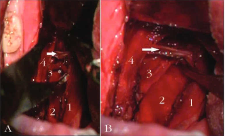 Figure 1. A: (without medial traction of the palatopharyngeal. 