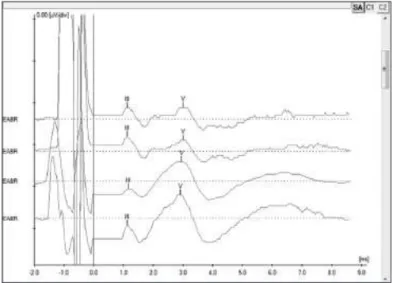 Figure 4. Electrically evoked brainstem responses measured during  surgery for subject 5 electrodes 19, 14, 9 and 6 using Interface  Navi-gator Pro and Software AEP version 7.0.0, Biologic
