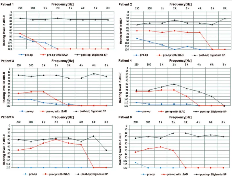 Figure 5. Pre and postoperative audiometric thresholds of six cochlear device implantation patients using Digisonic® SP