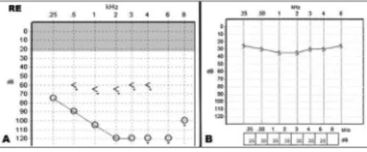 Figure 1. A: pre-operative right ear audiogram showing profound  sensorineural hearing loss