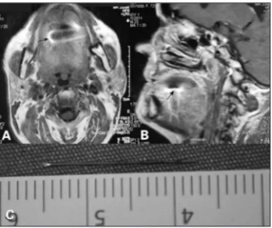 Figure 1. Image of the foreign body on axial (A) and sagittal (B)  sections of MR imaging (black arrow)