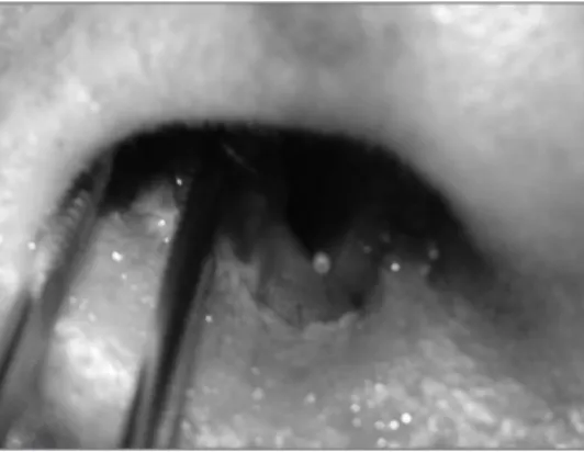 Figura 1. Lesão ulcerada em vestibulo nasal direito.