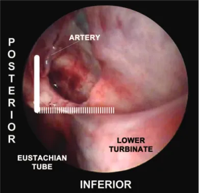 Figure 5. Picture of a left nasal fossa. The inferior border of the “sphe- “sphe-nopalatine quadrangle” is the superior portion of the inferior turbinate
