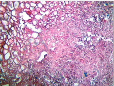 Figure 2.  Microphotography of a thyroid fusiform sarcoma. HE, 400x.