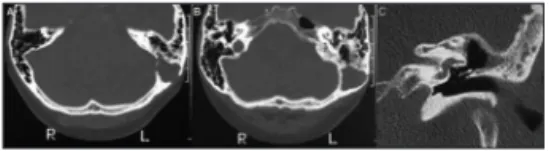 Figure 1. A-B: CT of the temporal bones. Axial images showed a  hypoattenuating and expansive lesion in the left mastoid process  eroding its medial and lateral walls, adjacent to the left sigmoid  sinus