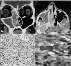 Figura 1. Tomograia computadorizada com contraste dos seios  paranasais - incidência axial (A) e coronal (B) - exibindo massa  volumosa na cavidade nasal direita estendendo-se até a fossa  pterigopalatina, com erosão da parede medial do seio maxilar,  lâmi