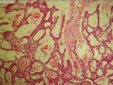 Figure 2. Plexiform pattern ameloblastoma, showing the cystic-type  degeneration. HE 100x.