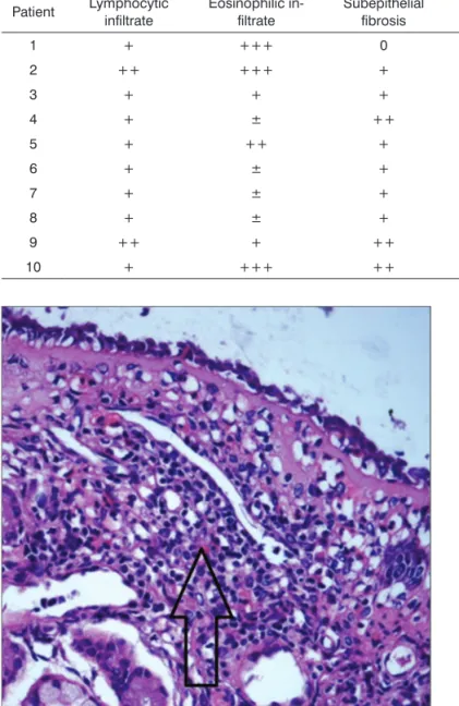 Table 2. Semi-quantitative analysis of nasal mucosa histopathology findings of patients with allergic rhinitis and negative serology  for HTLV-1 (controls)