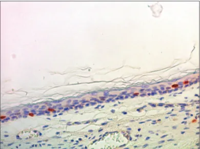 Figure 6. Micro-photography, showing the lower wall epidermis of the  external acoustic meatus with CK16 expression (IHQ–200x).