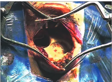 Figure 6. Ilustration of irrigation of the mastoid cavity and middle ear  with povidone-iodine solution (10% povidone-iodine / 1% active iodine).