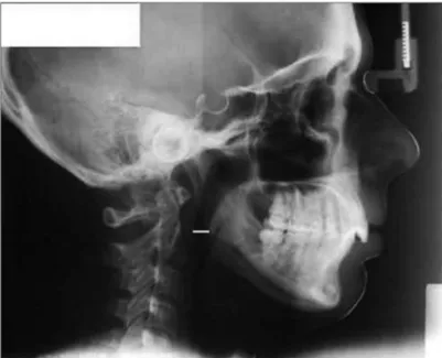 Figure 1. PAS (lower airway) Cephalometric value: pharynx width at  the point where, radiographically, the posterior tongue border crosses  the  inferior  mandible  border,  all  the  way  to  the  closest  point  to  the  posterior pharyngeal wall.