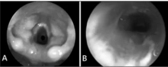 Figure 1. A - Direct laryngoscopy showing grade 2 (Myer-Cotton)  subglottic stenosis. B - Direct laryngoscopy on the seventh  posto-perative day showing in situ grafts and good subglottic patency.