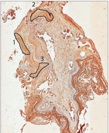 Figure 1. Scanned slide submitted to markings in three areas according  to the antibody reaction intensity (group 1)