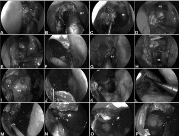 Figure 2. A-B: Intraoperative photographs demonstrating the resection  of a right ethmoidal adenocarcinoma