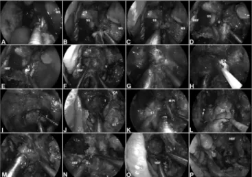 Figure 4. A: Malignant clival tumor extending laterally beyond the para- para-clival ICA; therefore, requiring endoscopic transpterygoid