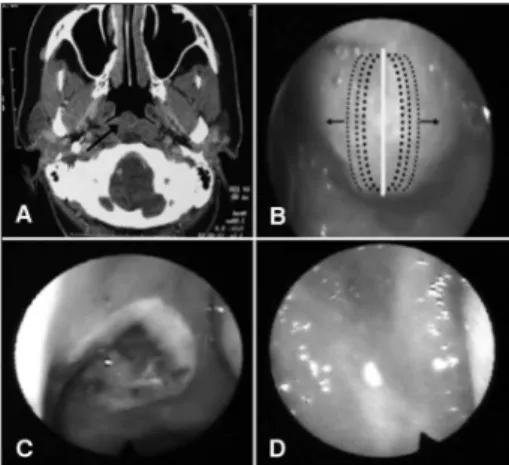 Figure 1. A: CT scan of the sinuses showing a lesion in the na- na-sopharynx; B: Direction of the vaporization of the free edges of  the cyst; C: Appearance of the surgical injury on the second day  postoperatively; D: Three months postoperatively, normal 