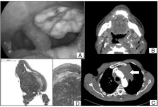 Figura 1. A: Aspecto macroscópico de lesão em loja amigdaliana  esquerda; B: TC de pescoço, corte axial (lecha branca: lesão de  orofaringe; lechas pretas: linfonodos); C: TC de tórax, corte axial  (lecha branca: massa em lobo superior esquerdo); D: Mucosa