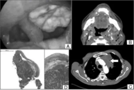 Figure 1. A: macroscopic view of a tumor in the left tonsillar bed; 