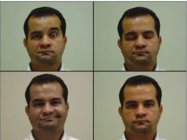 Figure 2. Anastomosis. Absent frontal muscle contraction to the right; 